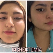 BICHECTOMÍA