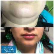 Mesolipoplastia de Papada y Rostro